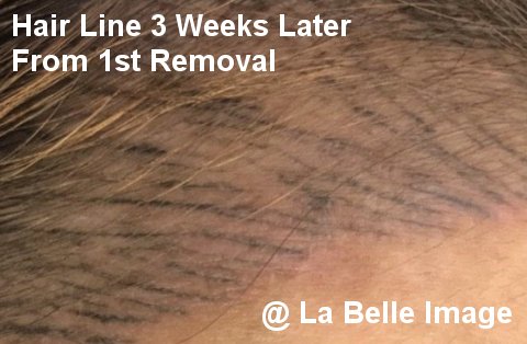 Hair Line Permanent Make Up 3 Weeks Later From 1st Removal